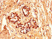 IHC image of CSB-PA010378OA96nforHU diluted at 1:50 and staining in paraffin-embedded human breast cancer performed on a Leica BondTM system. After dewaxing and hydration, antigen retrieval was mediated by high pressure in a citrate buffer (pH 6.0...