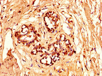 IHC image of CSB-PA010378OA96nforHU diluted at 1:50 and staining in paraffin-embedded human breast cancer performed on a Leica BondTM system. After dewaxing and hydration, antigen retrieval was mediated by high pressure in a citrate buffer (pH 6.0...
