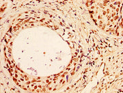 IHC image of CSB-PA010378OA96nhibHU diluted at 1:50 and staining in paraffin-embedded human cervical cancer performed on a Leica BondTM system. After dewaxing and hydration, antigen retrieval was mediated by high pressure in a citrate buffer (pH 6...