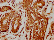 IHC image of CSB-PA010378PA109nforHU diluted at 1:20 and staining in paraffin-embedded human breast cancer performed on a Leica BondTM system. After dewaxing and hydration, antigen retrieval was mediated by high pressure in a citrate buffer (pH 6....