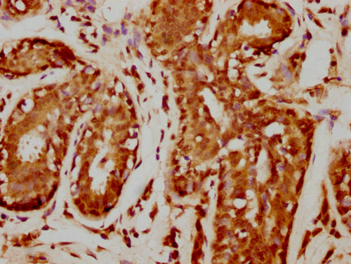 IHC image of CSB-PA010378PA109nforHU diluted at 1:20 and staining in paraffin-embedded human breast cancer performed on a Leica BondTM system. After dewaxing and hydration, antigen retrieval was mediated by high pressure in a citrate buffer (pH 6....