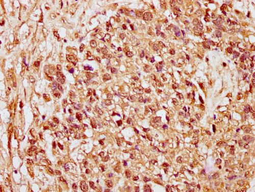 IHC image of CSB-PA010378PA89nacHU diluted at 1:15 and staining in paraffin-embedded human ovarian cancer performed on a Leica BondTM system. After dewaxing and hydration, antigen retrieval was mediated by high pressure in a citrate buffer (pH 6.0...