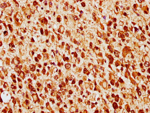 IHC image of CSB-PA010379OA140nforHU diluted at 1:14 and staining in paraffin-embedded human glioma cancer performed on a Leica BondTM system. After dewaxing and hydration, antigen retrieval was mediated by high pressure in a citrate buffer (pH 6....