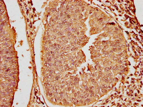 IHC image of CSB-PA010379OA16nme1HU diluted at 1:20 and staining in paraffin-embedded human cervical cancer performed on a Leica BondTM system. After dewaxing and hydration, antigen retrieval was mediated by high pressure in a citrate buffer (pH 6...