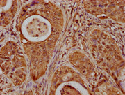 IHC image of CSB-PA010379OA85nbhbHU diluted at 1:20 and staining in paraffin-embedded human cervical cancer performed on a Leica BondTM system. After dewaxing and hydration, antigen retrieval was mediated by high pressure in a citrate buffer (pH 6...