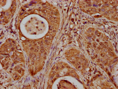 IHC image of CSB-PA010379OA85nbhbHU diluted at 1:20 and staining in paraffin-embedded human cervical cancer performed on a Leica BondTM system. After dewaxing and hydration, antigen retrieval was mediated by high pressure in a citrate buffer (pH 6...