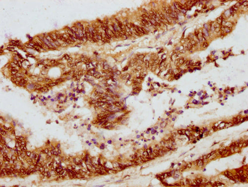 IHC image of CSB-PA010380OA01nphHU diluted at 1:10 and staining in paraffin-embedded human colon cancer performed on a Leica BondTM system. After dewaxing and hydration, antigen retrieval was mediated by high pressure in a citrate buffer (pH 6.0)....