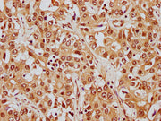 IHC image of CSB-PA010380OA26nphHU diluted at 1:8 and staining in paraffin-embedded human liver cancer performed on a Leica BondTM system. After dewaxing and hydration, antigen retrieval was mediated by high pressure in a citrate buffer (pH 6.0)....