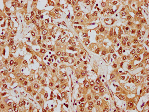 IHC image of CSB-PA010380OA26nphHU diluted at 1:8 and staining in paraffin-embedded human liver cancer performed on a Leica BondTM system. After dewaxing and hydration, antigen retrieval was mediated by high pressure in a citrate buffer (pH 6.0)....