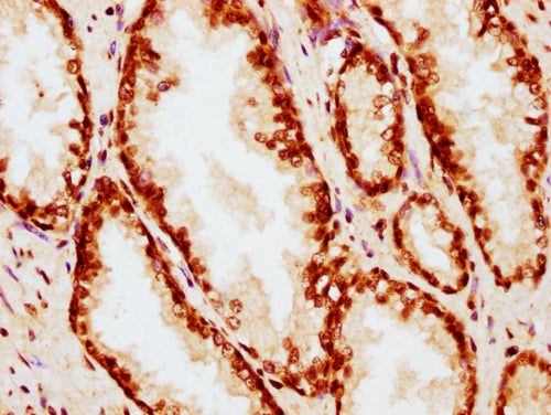 IHC image of CSB-PA010380OA35nphHU diluted at 1:20 and staining in paraffin-embedded human prostate cancer performed on a Leica BondTM system. After dewaxing and hydration, antigen retrieval was mediated by high pressure in a citrate buffer (pH 6....