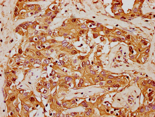 IHC image of CSB-PA010380OA62nforHU diluted at 1:20 and staining in paraffin-embedded human liver cancer performed on a Leica BondTM system. After dewaxing and hydration, antigen retrieval was mediated by high pressure in a citrate buffer (pH 6.0)...