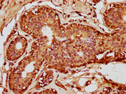 IHC image of CSB-PA010380OA63nforHU diluted at 1:10 and staining in paraffin-embedded human breast cancer performed on a Leica BondTM system. After dewaxing and hydration, antigen retrieval was mediated by high pressure in a citrate buffer (pH 6.0...
