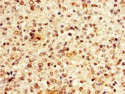 Immunohistochemistry of paraffin-embedded human glioma using CSB-PA010380PA63nacHU at dilution of 1:100