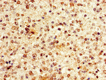 Immunohistochemistry of paraffin-embedded human glioma using CSB-PA010380PA63nacHU at dilution of 1:100