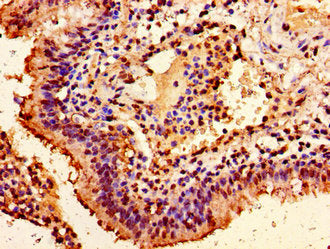Immunohistochemistry of paraffin-embedded human lung cancer using CSB-PA010380PA63ncrHU at dilution of 1:100