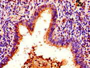 Immunohistochemistry of paraffin-embedded human lung cancer using CSB-PA010380PA63nforHU at dilution of 1:100