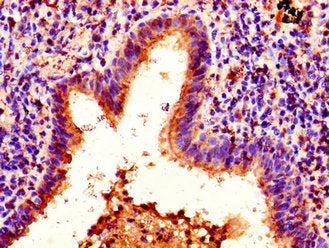 Immunohistochemistry of paraffin-embedded human lung cancer using CSB-PA010380PA63nforHU at dilution of 1:100