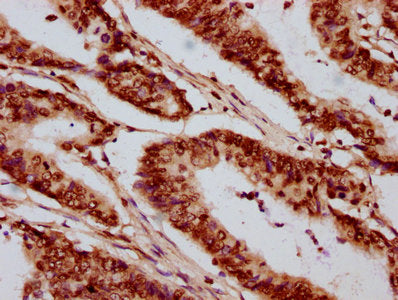 IHC image of CSB-PA010389OA05nbutHU diluted at 1:20 and staining in paraffin-embedded human colon cancer performed on a Leica BondTM system. After dewaxing and hydration, antigen retrieval was mediated by high pressure in a citrate buffer (pH 6.0)...