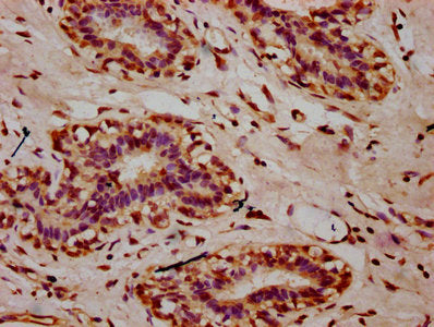 IHC image of CSB-PA010389OA09nacHU diluted at 1:10 and staining in paraffin-embedded human breast cancer performed on a Leica BondTM system. After dewaxing and hydration, antigen retrieval was mediated by high pressure in a citrate buffer (pH 6.0)...