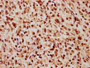 IHC image of CSB-PA010389OA09nbhbHU diluted at 1:20 and staining in paraffin-embedded human glioma performed on a Leica BondTM system. After dewaxing and hydration, antigen retrieval was mediated by high pressure in a citrate buffer (pH 6.0). Sect...
