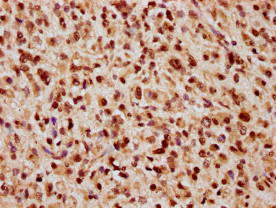 IHC image of CSB-PA010389OA09nbhbHU diluted at 1:20 and staining in paraffin-embedded human glioma performed on a Leica BondTM system. After dewaxing and hydration, antigen retrieval was mediated by high pressure in a citrate buffer (pH 6.0). Sect...