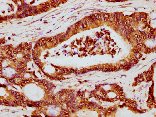 IHC image of CSB-PA010389OA119ncrHU diluted at 1:5 and staining in paraffin-embedded human colon cancer performed on a Leica BondTM system. After dewaxing and hydration, antigen retrieval was mediated by high pressure in a citrate buffer (pH 6.0)....