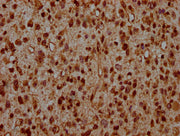 IHC image of CSB-PA010389OA95ncrHU diluted at 1:20 and staining in paraffin-embedded human glioma performed on a Leica BondTM system. After dewaxing and hydration, antigen retrieval was mediated by high pressure in a citrate buffer (pH 6.0). Secti...