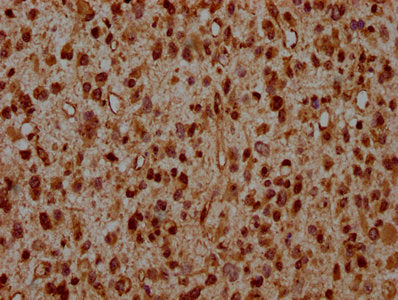 IHC image of CSB-PA010389OA95ncrHU diluted at 1:20 and staining in paraffin-embedded human glioma performed on a Leica BondTM system. After dewaxing and hydration, antigen retrieval was mediated by high pressure in a citrate buffer (pH 6.0). Secti...