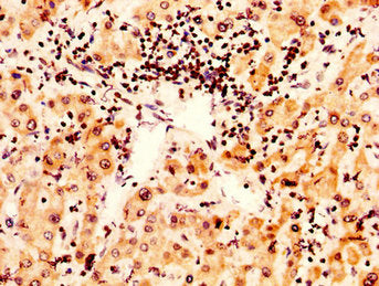 IHC image of CSB-PA010389OA95nsucHU diluted at 1:50 and staining in paraffin-embedded human liver cancer performed on a Leica BondTM system. After dewaxing and hydration, antigen retrieval was mediated by high pressure in a citrate buffer (pH 6.0)...