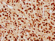 IHC image of CSB-PA010389PA09nacHU diluted at 1:10 and staining in paraffin-embedded human glioma cancer performed on a Leica BondTM system. After dewaxing and hydration, antigen retrieval was mediated by high pressure in a citrate buffer (pH 6.0)...