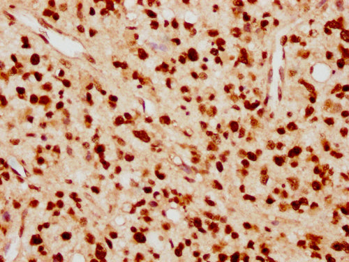 IHC image of CSB-PA010389PA09nacHU diluted at 1:10 and staining in paraffin-embedded human glioma cancer performed on a Leica BondTM system. After dewaxing and hydration, antigen retrieval was mediated by high pressure in a citrate buffer (pH 6.0)...