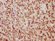 IHC image of CSB-PA010389PA29nme1HU diluted at 1:10 and staining in paraffin-embedded human ovarian cancer performed on a Leica BondTM system. After dewaxing and hydration, antigen retrieval was mediated by high pressure in a citrate buffer (pH 6....