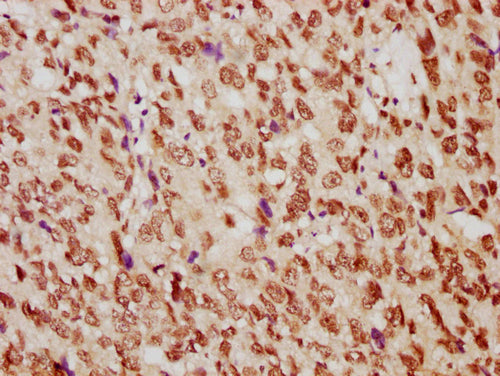 IHC image of CSB-PA010389PA29nme1HU diluted at 1:10 and staining in paraffin-embedded human ovarian cancer performed on a Leica BondTM system. After dewaxing and hydration, antigen retrieval was mediated by high pressure in a citrate buffer (pH 6....