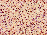 Immunohistochemistry of paraffin-embedded human glioma using CSB-PA010389PA36ncrHU at dilution of 1:100