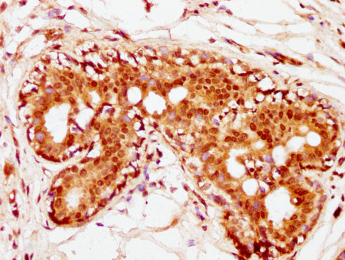 IHC image of CSB-PA010389PA36nhibHU diluted at 1:10 and staining in paraffin-embedded human breast cancer performed on a Leica BondTM system. After dewaxing and hydration, antigen retrieval was mediated by high pressure in a citrate buffer (pH 6.0...