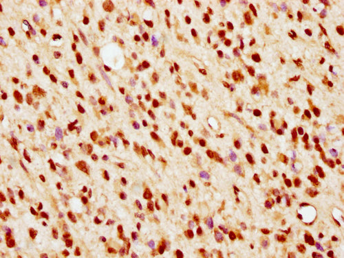 IHC image of CSB-PA010389PA36nsucHU diluted at 1:10 and staining in paraffin-embedded human glioma cancer performed on a Leica BondTM system. After dewaxing and hydration, antigen retrieval was mediated by high pressure in a citrate buffer (pH 6.0...