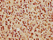 IHC image of CSB-PA010389PA74nhibHU diluted at 1:5 and staining in paraffin-embedded human glioma cancer performed on a Leica BondTM system. After dewaxing and hydration, antigen retrieval was mediated by high pressure in a citrate buffer (pH 6.0)...