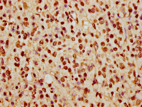 IHC image of CSB-PA010389PA74nhibHU diluted at 1:5 and staining in paraffin-embedded human glioma cancer performed on a Leica BondTM system. After dewaxing and hydration, antigen retrieval was mediated by high pressure in a citrate buffer (pH 6.0)...
