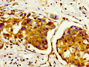 Immunohistochemistry of paraffin-embedded human breast cancer using CSB-PA010389PA95nhibHU at dilution of 1:100