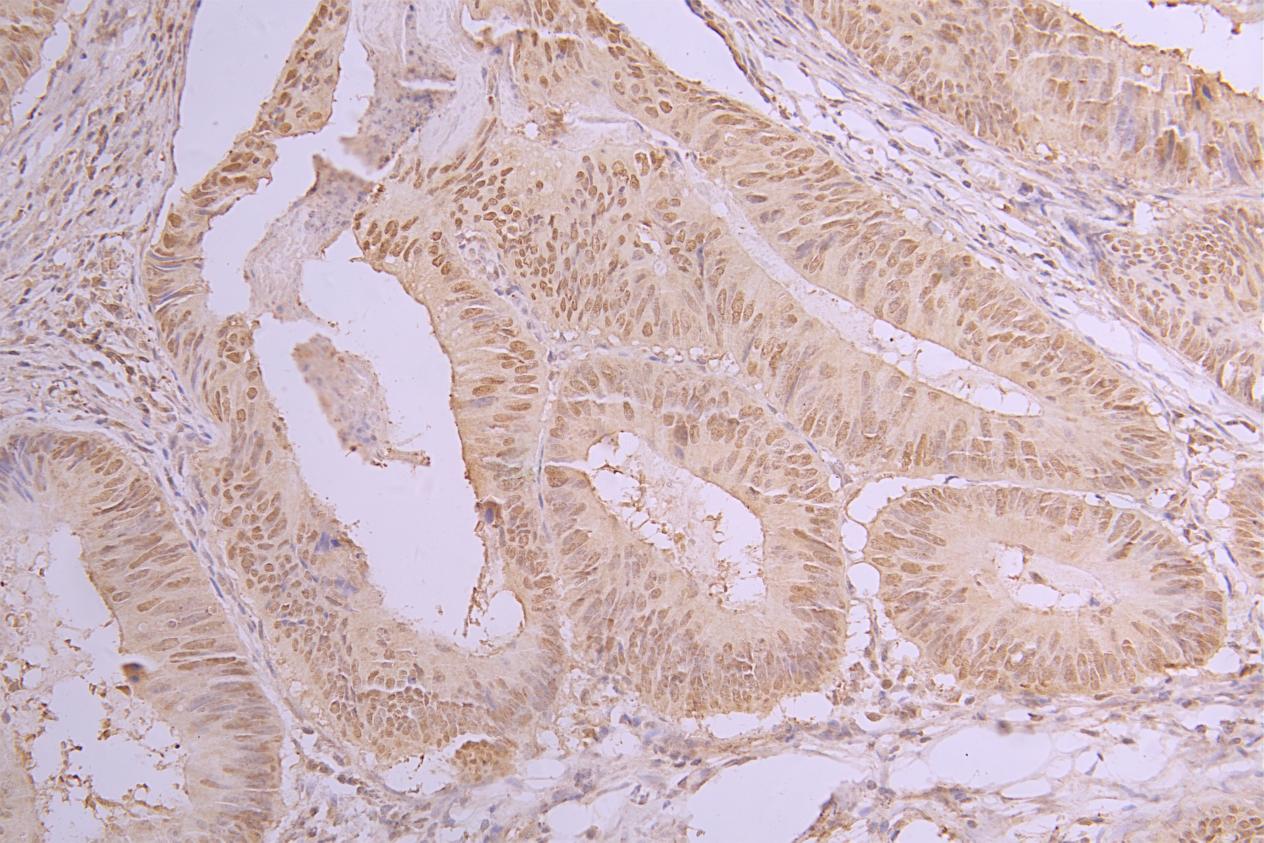 IHC image of CSB-PA010402NA05nacHU diluted at 1:150 and staining in paraffin-embedded human colorectal cancer performed on a Leica BondTM system. After dewaxing and hydration, antigen retrieval was mediated by high pressure in a citrate buffer (pH...