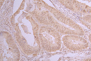 IHC image of CSB-PA010402NA05nacHU diluted at 1:150 and staining in paraffin-embedded human colorectal cancer performed on a Leica BondTM system. After dewaxing and hydration, antigen retrieval was mediated by high pressure in a citrate buffer (pH...