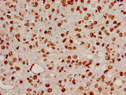 Immunohistochemistry of paraffin-embedded human glioma using CSB-PA010402PA05nacHU at dilution of 1:100