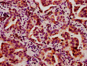 IHC image of CSB-PA010403OA05nbhbHU diluted at 1:10 and staining in paraffin-embedded human lung cancer performed on a Leica BondTM system. After dewaxing and hydration, antigen retrieval was mediated by high pressure in a citrate buffer (pH 6.0)....