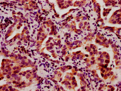 IHC image of CSB-PA010403OA05nbhbHU diluted at 1:10 and staining in paraffin-embedded human lung cancer performed on a Leica BondTM system. After dewaxing and hydration, antigen retrieval was mediated by high pressure in a citrate buffer (pH 6.0)....