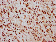 IHC image of CSB-PA010403OA05ncrHU diluted at 1:20 and staining in paraffin-embedded human glioma performed on a Leica BondTM system. After dewaxing and hydration, antigen retrieval was mediated by high pressure in a citrate buffer (pH 6.0). Secti...