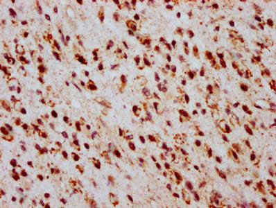 IHC image of CSB-PA010403OA05ncrHU diluted at 1:20 and staining in paraffin-embedded human glioma performed on a Leica BondTM system. After dewaxing and hydration, antigen retrieval was mediated by high pressure in a citrate buffer (pH 6.0). Secti...
