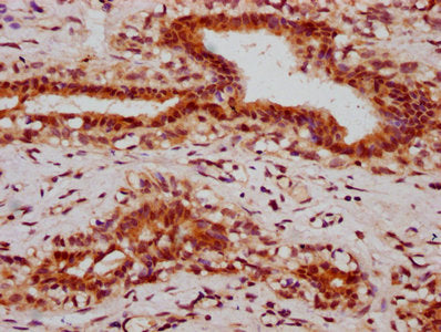 IHC image of CSB-PA010403OA05ngluHU diluted at 1:10 and staining in paraffin-embedded human breast cancer performed on a Leica BondTM system. After dewaxing and hydration, antigen retrieval was mediated by high pressure in a citrate buffer (pH 6.0...