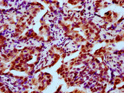 IHC image of CSB-PA010403OA05nhibHU diluted at 1:10 and staining in paraffin-embedded human lung cancer performed on a Leica BondTM system. After dewaxing and hydration, antigen retrieval was mediated by high pressure in a citrate buffer (pH 6.0)....