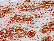 IHC image of CSB-PA010403OA120nacHU diluted at 1:10 and staining in paraffin-embedded human breast cancer performed on a Leica BondTM system. After dewaxing and hydration, antigen retrieval was mediated by high pressure in a citrate buffer (pH 6.0...