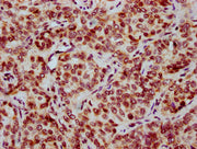 IHC image of CSB-PA010403OA12nbutHU diluted at 1:20 and staining in paraffin-embedded human liver cancer performed on a Leica BondTM system. After dewaxing and hydration, antigen retrieval was mediated by high pressure in a citrate buffer (pH 6.0)...